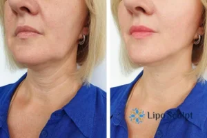 Double chin before and after Hi-Fu treatment 4 Book your double chin treatment West Malling today! We are here to help!