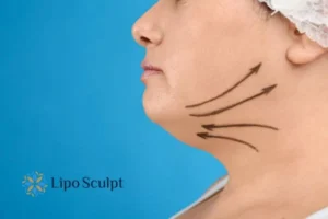 Double chin before and after Hi-Fu treatment 3 Boost your confidence with a Double chin treatment West Malling