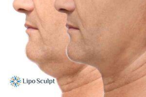 Double chin before and after Hi-Fu treatment 2 Double chin treatment West Malling from Lipo Sculpt - feel more confident today!