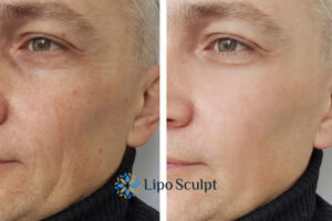 How to Fight Aging Symptoms 3 Fight Aging Symptoms West Malling With HIFU and Morpheus8 Today!