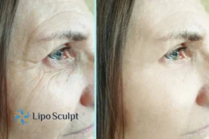 How to Fight Aging Symptoms 2 Do you want to Fight Aging Symptoms West Malling? Contact Lipo Sculpt today!