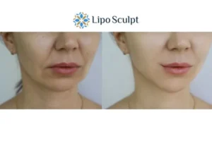 Explaining Total Skin Tightening Treatment And What It Can Do For You 2 Do you want to boost your self confidence? Give Morpheus8 West Malling a try today!