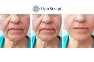 Explaining Total Skin Tightening Treatment And What It Can Do For You 3 Boost your confidence with Morpheus8 West Malling call our team today!