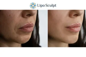 Explaining Total Skin Tightening Treatment And What It Can Do For You 4 Morpheus8 West Malling the best results - call our team today!
