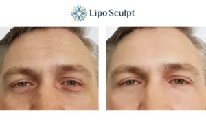 Explaining Total Skin Tightening Treatment And What It Can Do For You 6 Morpheus8 West Malling book in today to find out more!