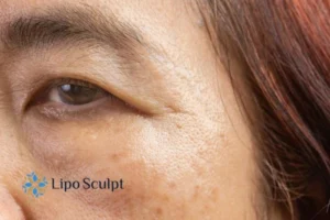 Cryopen: The Revolutionary Treatment for Age Spots Unveiled 2 Are age spots West Malling giving you low self esteem? Contact us today!