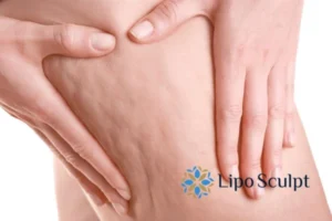 CoolSculpting for Legs: The Innovative Approach to Redefining Your Legs 5 Start your journey today book your coolsculpting treatment West Malling online today!