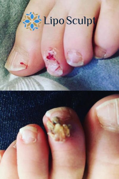 Wart removal customer results from Lipo Sculpt West Malling
