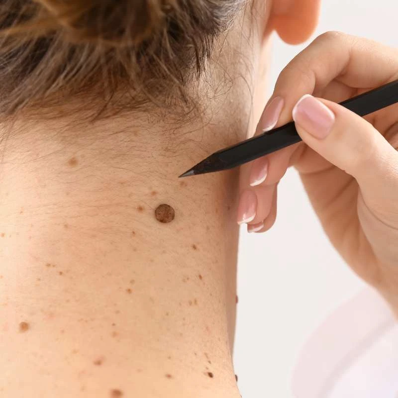 How to Support Your Body During Pregnancy for Faster Postnatal Recovery 5 See our lesion removal prices West Malling - call today for a free quote