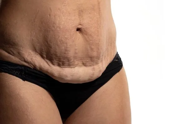 Lost the Weight but Not the Loose Skin? 1 image of womans stomach after weight loss showing loose skin West Malling